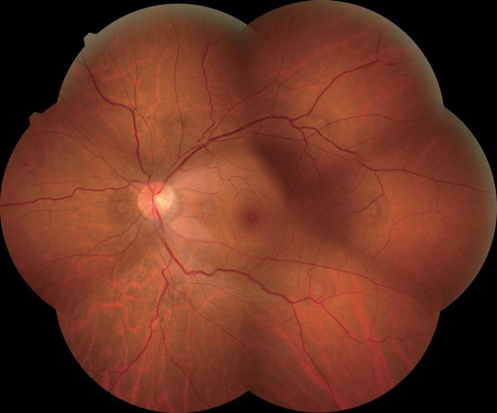 Dépistage de la Rétinopathie Diabétique